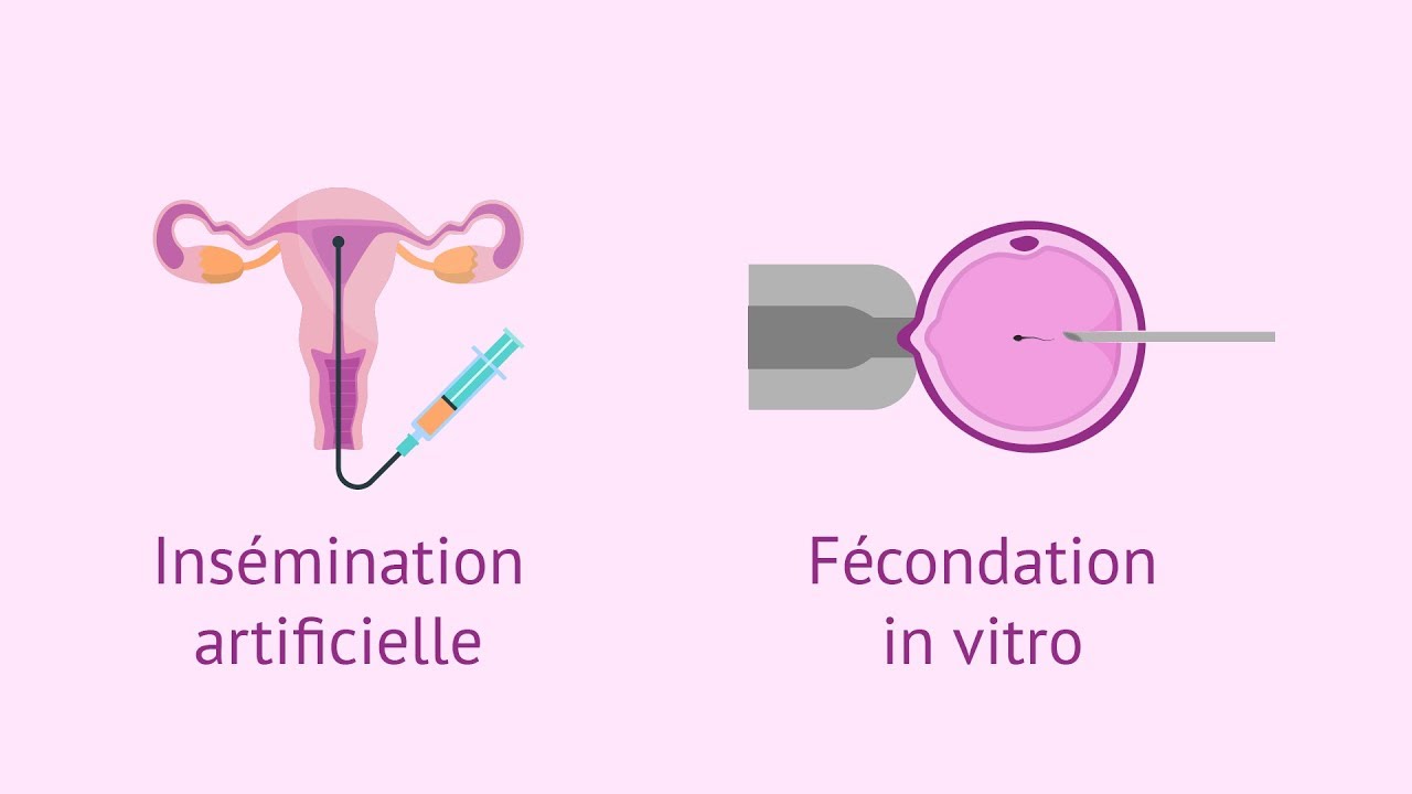Procréation médicalement assistée : 5 étapes clés pour réussir 5 procréation médicalement assistée