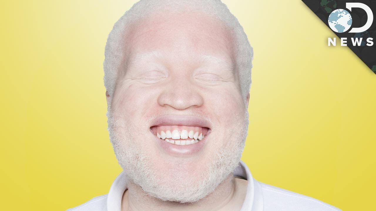Albino: 7 curiosidades surpreendentes que você precisa saber
