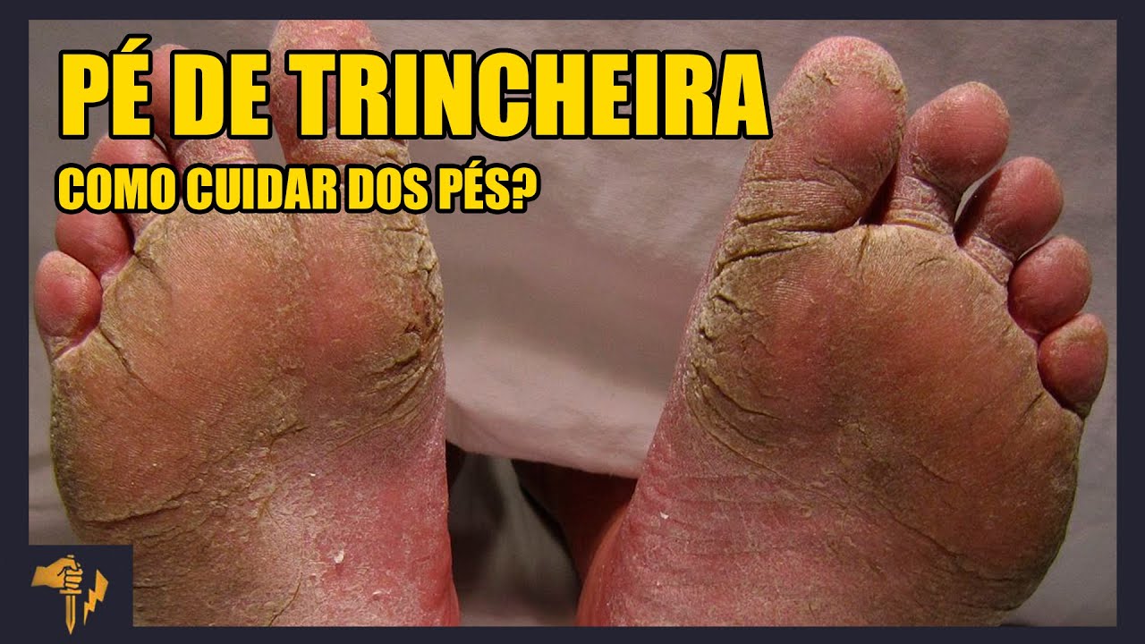 Pe de trincheira: 7 benefícios surpreendentes que você deve conhecer 4 pe de trincheira