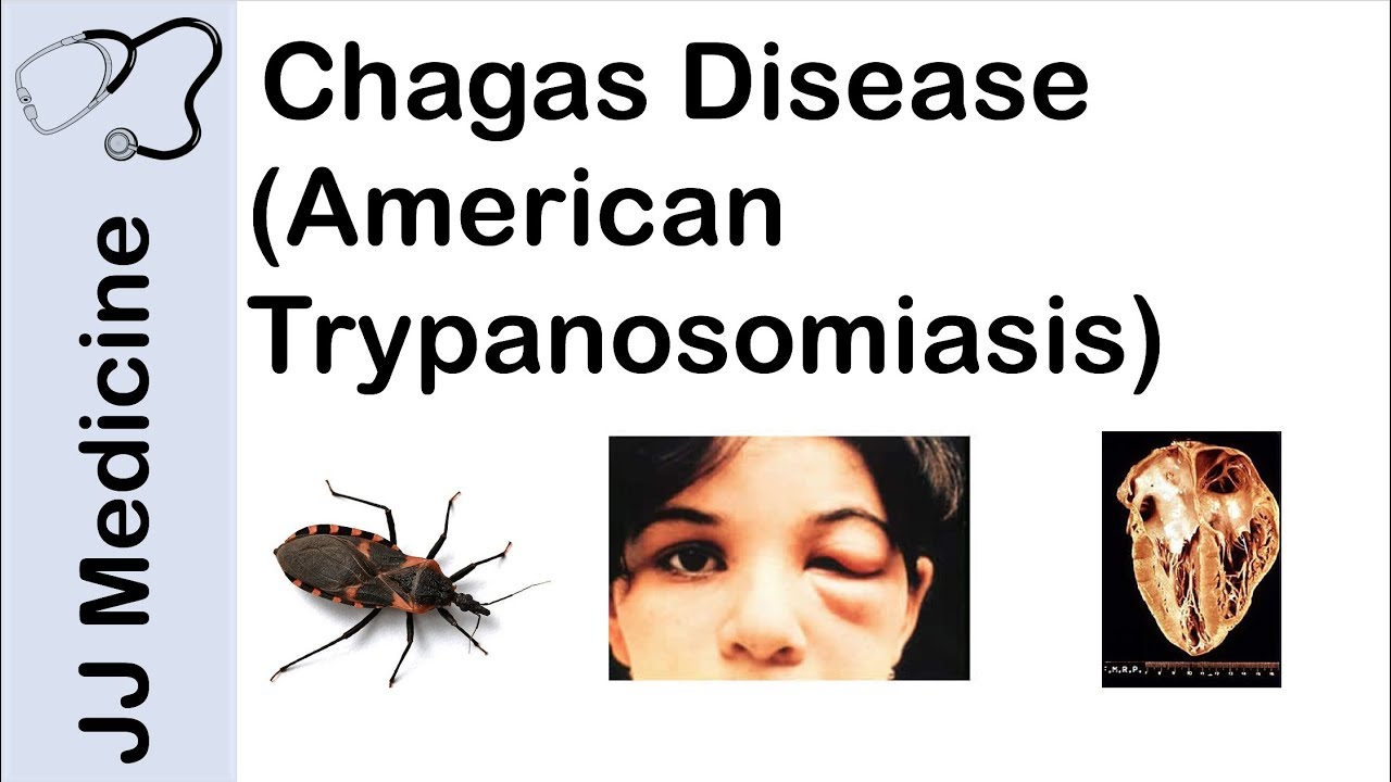 chagas