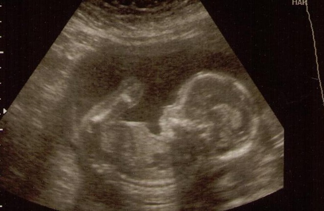 Decisión sobre bebé de mujer con muerte cerebral "prudencial"