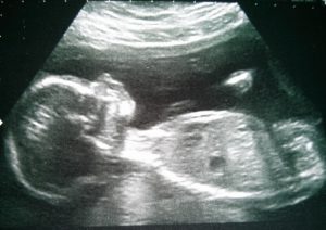 Escaneo de bebé de 20 semanas.